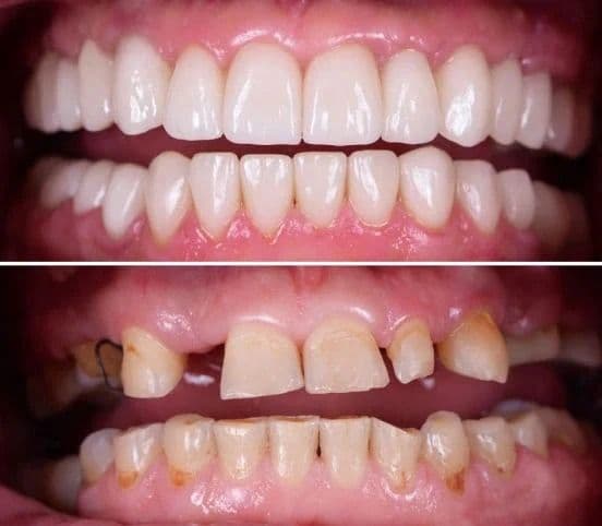 Full Mouth Rehabilitation at Kaleidoscope Dental Specialists, Marylebone London