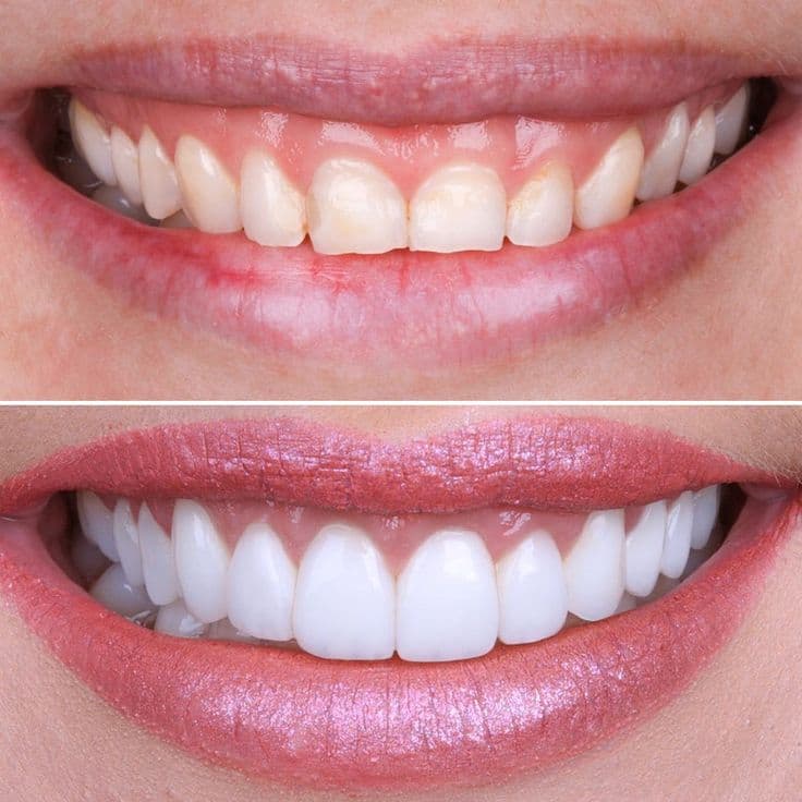 Smile Makeovers (Veneers) at Kaleidoscope Dental Specialists, Marylebone London